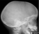 Craniosynostosis